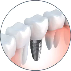 Dental-Implant