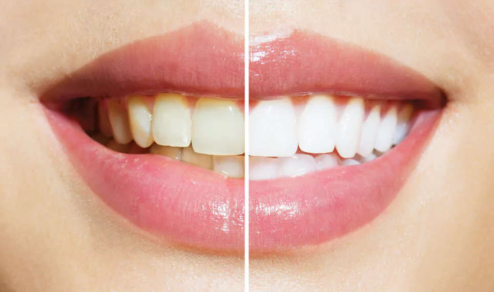 Teeth-Whitening